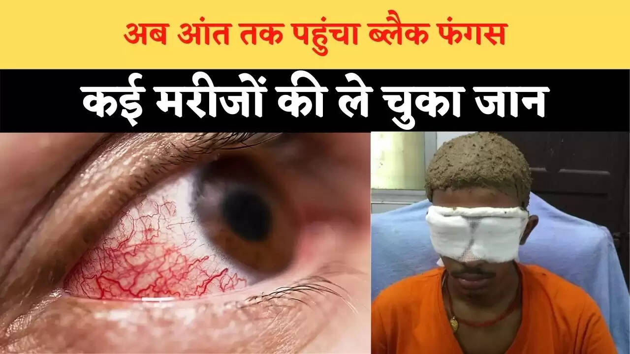 अब आंत तक पहुंचा ब्लैक फंगस, कई मरीजों की ले चुका जान