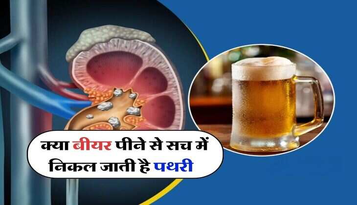 wine beer : क्या बीयर पीने से सच में निकल जाती है पथरी, जानिये इसका सच