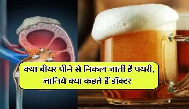 beer : क्या बीयर पीने से निकल जाती है पथरी, जानिये क्या कहते हैं डॉक्टर