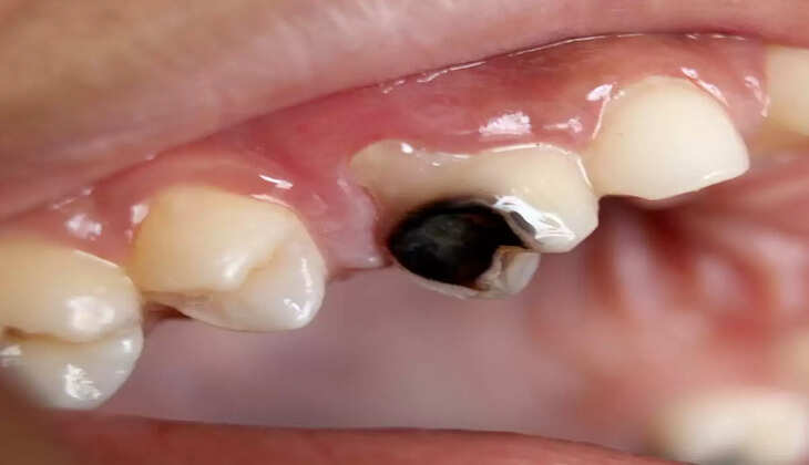 ऐसे घर में हर्बल पाउडर बनाकर दांतों के काले कीड़े करें दूर  